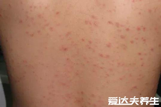 玫瑰糠疹怎么引起的会传染吗,不会传染但病因不详(图片)