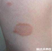 玫瑰糠疹图片及症状，从掌心大小母斑扩散