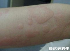 多种荨麻疹初期症状图片,突发形态不一的