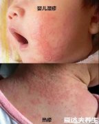 湿疹和热疹的区别图片,一眼就看出症状其