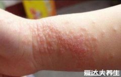 湿疹图片初期症状图片,密集小水泡融合成