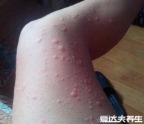荨麻疹图片和症状,全身呈现大小不一的鲜