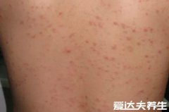 玫瑰糠疹怎么引起的会传染吗，不会传染但