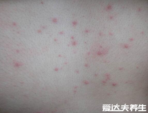 水痘早期图片大全,水痘刚开始的样子是红点很快转为水泡