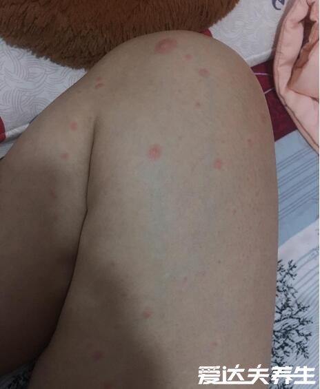 小孩出水痘的症状和图片,千万不能抓破否则会留疤