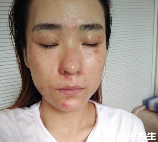 身上起红疙瘩很痒图片,如果是疥疮一定要及时治疗(会传染)
