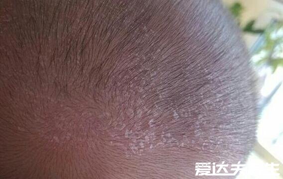 身上起红疙瘩很痒图片,如果是疥疮一定要及时治疗(会传染)