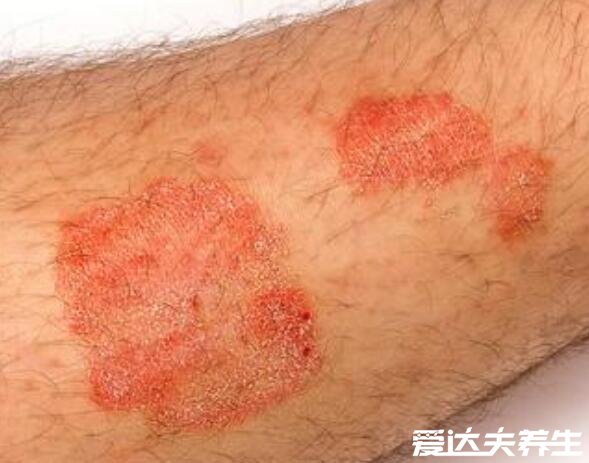 身上起红疙瘩很痒图片,如果是疥疮一定要及时治疗(会传染)
