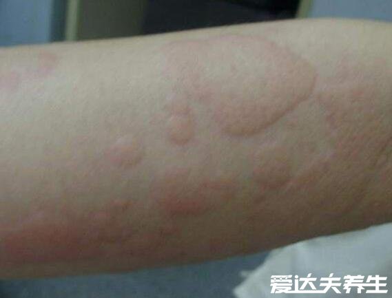 身上起红疙瘩很痒图片,如果是疥疮一定要及时治疗(会传染)