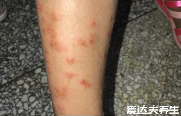跳蚤咬过后的疙瘩照片,一条线或三角形红疹子就是跳蚤杰作