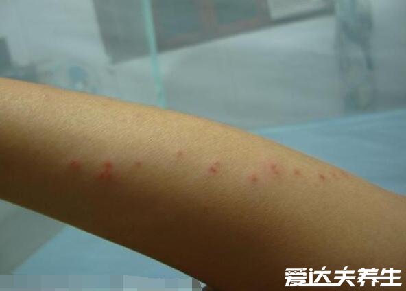 跳蚤咬过后的疙瘩照片,一条线或三角形红疹子就是跳蚤杰作