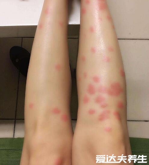 跳蚤咬过后的疙瘩照片,一条线或三角形红疹子就是跳蚤杰作