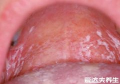 婴儿鹅口疮最早期图片，雪口病与奶苔不同