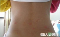 水痘早期图片大全，水痘刚开始的样子是红