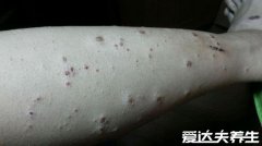 身上起红疙瘩很痒图片，如果是疥疮一定要