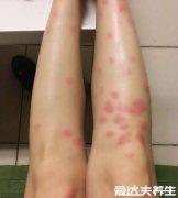 跳蚤咬过后的疙瘩照片,一条线或三角形红