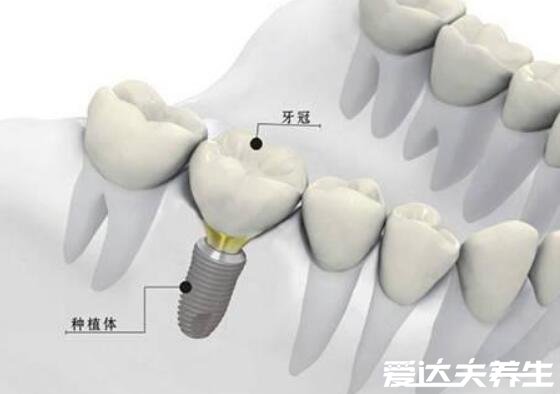 良心医生不建议种植牙，因人而异(有全身性疾病等5类人不建议做)