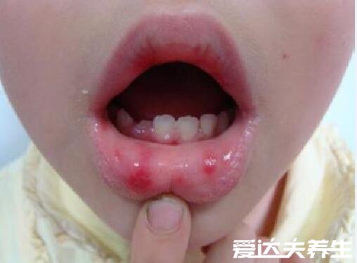 手足口病症状初期图片,如有相似尽快就医(附治疗事项)