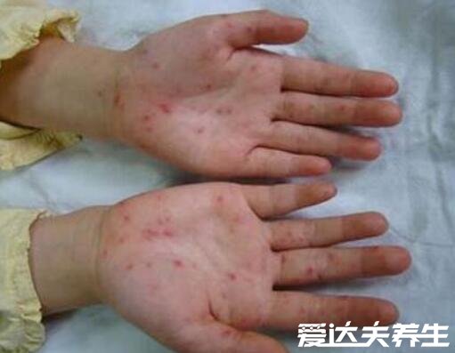 手足口病症状初期图片,如有相似尽快就医(附治疗事项)