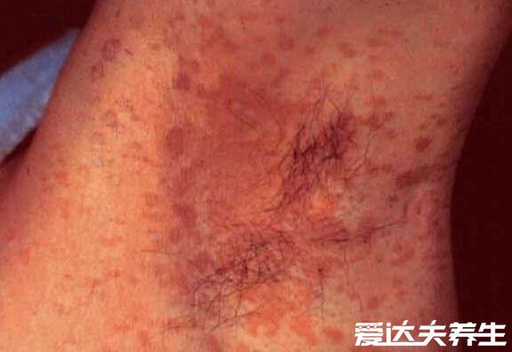 真实的早期花斑癣图片,危险性不大但真的超难看