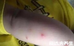 水痘刚开始的样子图片，全透明大小不一遍