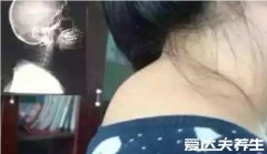 富贵包怎么消除最有效，不想手术就通过特