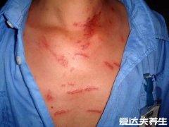 真实的隐翅虫咬人后图片，轻轻吹走并不