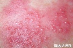 水痘早期图片大全，出现水痘不可怕(10天左