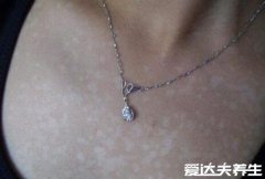 真实的早期花斑癣图片,危险性不大但真的