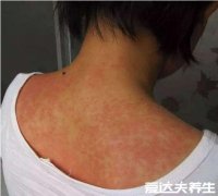 床上螨虫咬的症状图片,全身红色斑点瘙痒