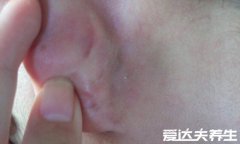耳垂里面长了个硬疙瘩是什么原因，内分泌