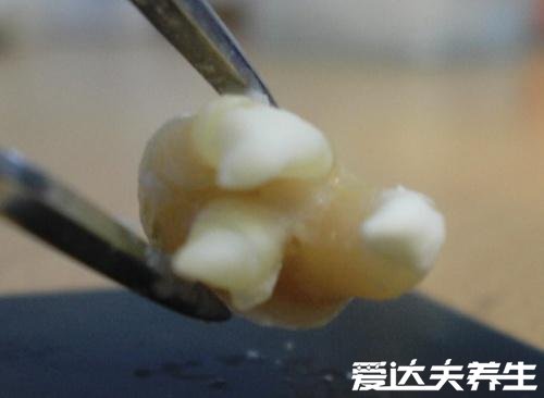 最难拔的智齿图,横生牙齿要锯开骨头还影响神经