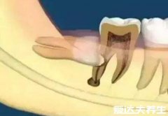 最难拔的智齿图,横生牙齿要锯开骨头还影