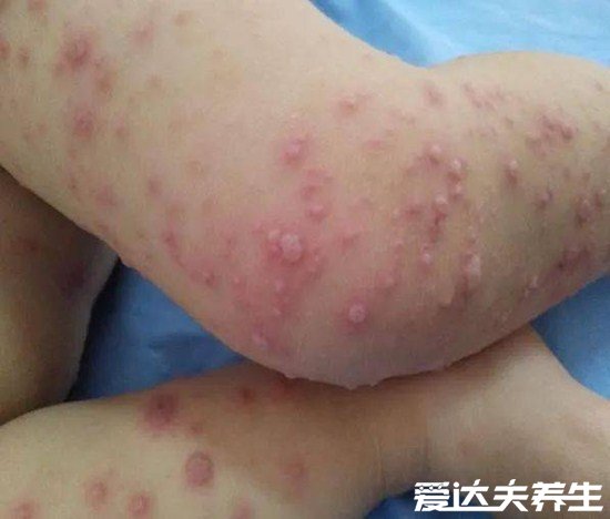 小儿手足口病最早期图片,遇到重症请立即就医否则有生命威胁