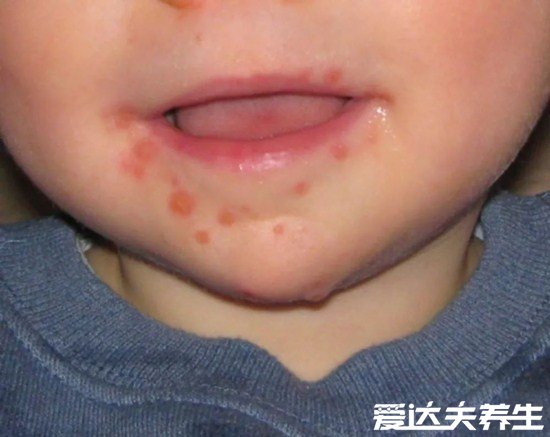 小儿手足口病最早期图片,遇到重症请立即就医否则有生命威胁