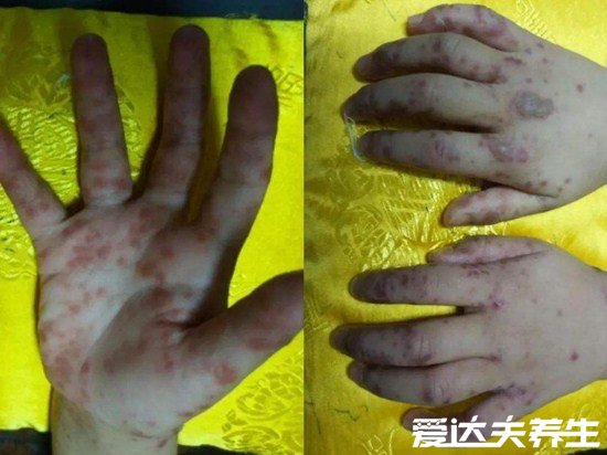 小儿手足口病最早期图片,遇到重症请立即就医否则有生命威胁