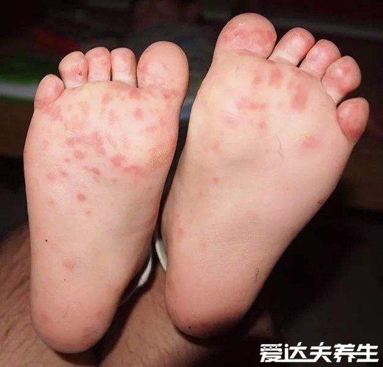 小儿手足口病最早期图片,遇到重症请立即就医否则有生命威胁
