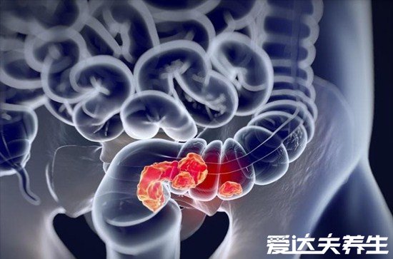 4个最为明显的肠癌信号预警,大便问题可不只是消化不良