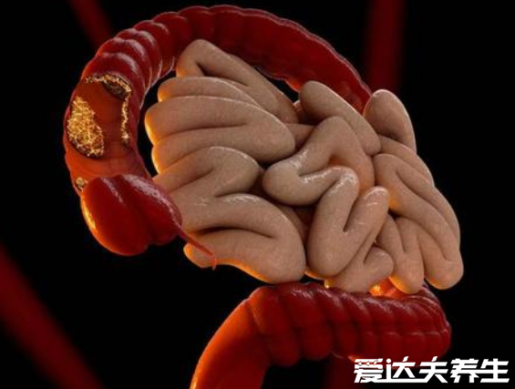 做了无痛肠镜很后悔,这4点你必须知道(严重可能致肠管破裂)