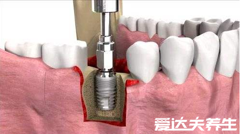 良心医生不建议种植牙，周期长费用高都不是重点第四点才致命