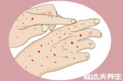 白血病初期小红点图片,千万不要被皮肤病