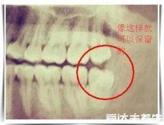 看清不需要拔的智齿图片，可能成为你其他