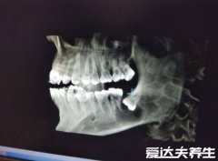 史上最难拔的智齿图，倒长在肉里需要切骨