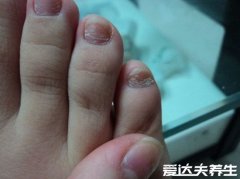 不同病症最轻微的灰指甲图片,指甲内出现