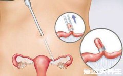 为什么不建议女人上环，不能百分百避孕甚