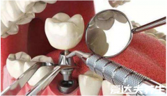 良心医生不建议种植牙，周期长费用高都不