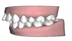 校正牙齿的年龄,四种不同畸形类型最佳矫