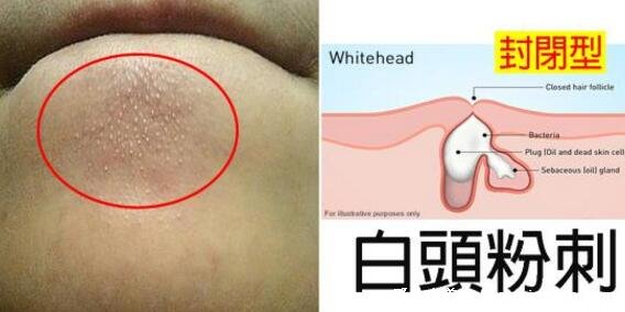 面部痤疮图片,粉刺/丘疹/脓包型/结节性/囊肿性痤疮合集