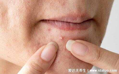 面部痤疮图片,粉刺/丘疹/脓包型/结节性/囊肿性痤疮合集