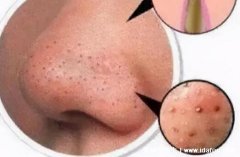 面部痤疮图片,粉刺/丘疹/脓包型/结节性/囊